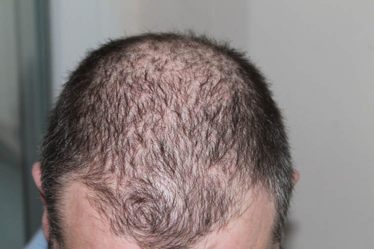 hair loss